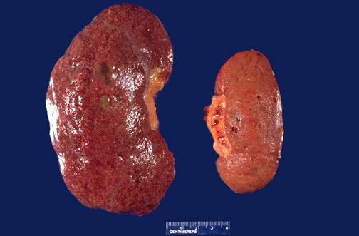 Renal Pathology