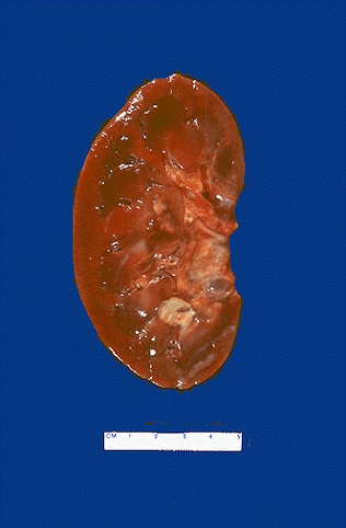 Renal Pathology