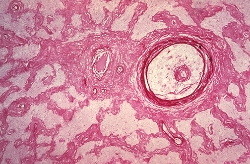 Ophthalmic Pathology