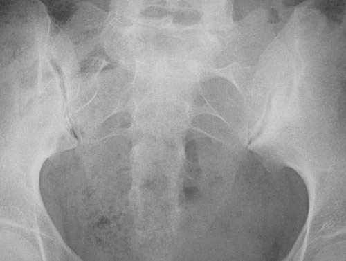 sacroiliac joint x ray