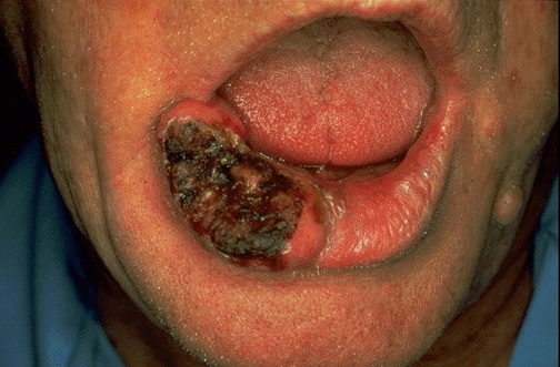 basal cell carcinoma lip