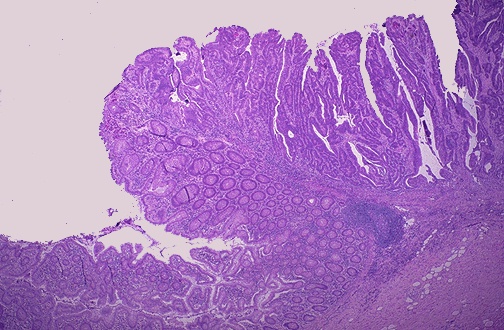 Аденома с интраэпителиальной неоплазией low grade. Аденокарцинома Толстого кишечника гистология. Ворсинчатая аденома толстой кишки микропрепарат. Аденокарцинома кишки микропрепарат. Аденокарцинома в ворсинчатой аденоме толстой кишки микропрепарат.
