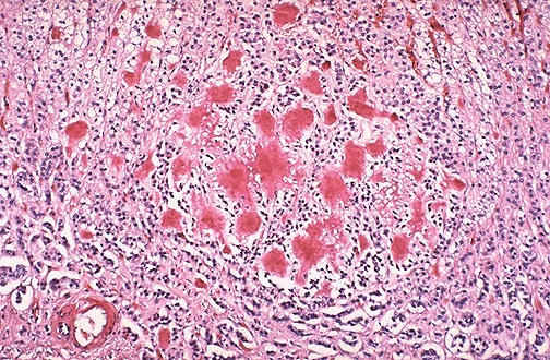 Endocrine Pathology