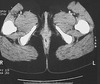 scan ct abdominal female tau pelvis normal