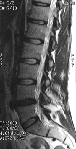 Spine MRI Scan, Sagittal