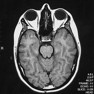 Pituitary Gland Mri Axial