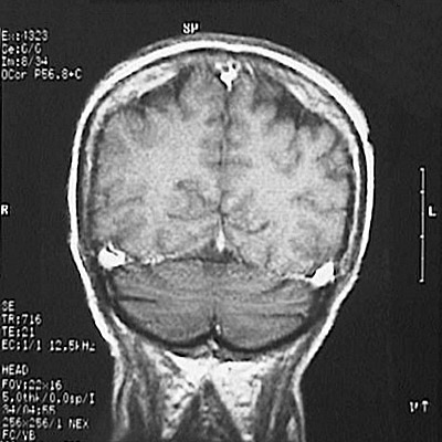 MRI, Coronal T1 Weighted