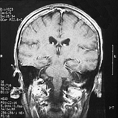 MRI, Coronal T1 Weighted