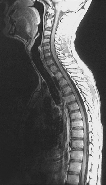 Spine MRI Scan, Sagittal