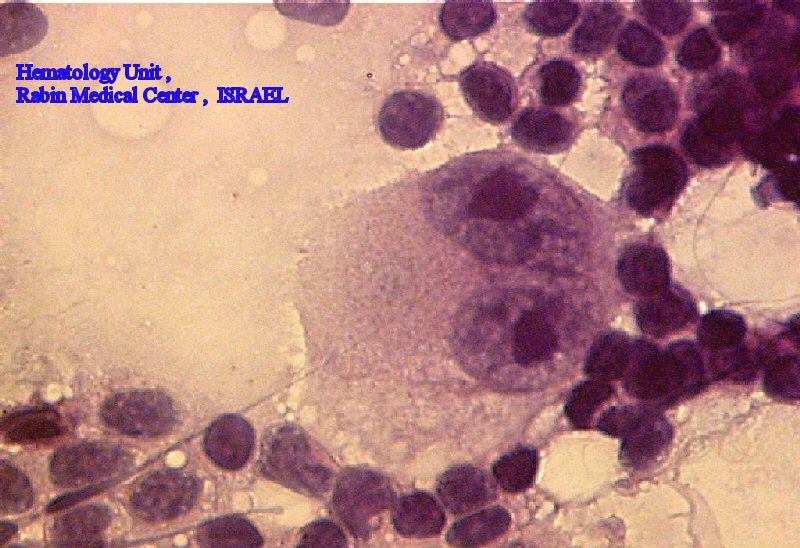 Hodgkin's Lymphoma - RS cell