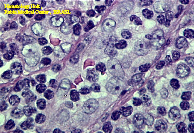 Hodgkin's Lymphoma - RS cells